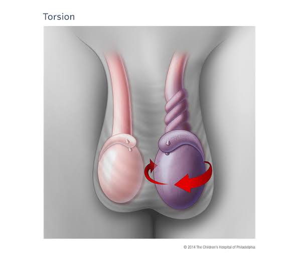 Testicular Torsion — The Pain That Can Cost You a Testicle... 

Sudden, intense testicular pain?
Swollen scrotum? Nausea out of nowhere?

You could be dealing with testicular torsion — a urological emergency... 

Delay = Dead testicle. 
⚠️ THREAD 🧵
