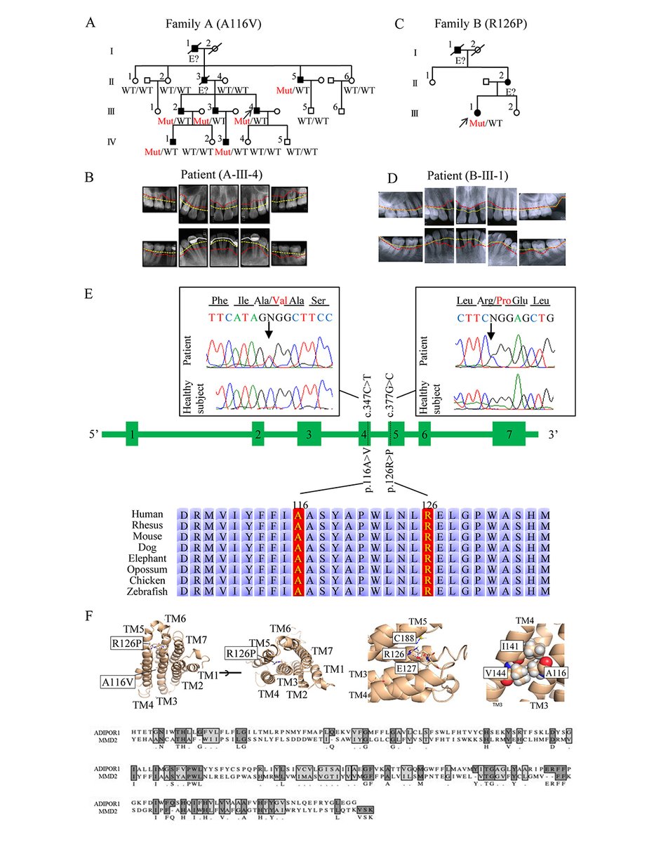 JExpMed's tweet image. Mizuno lab @HiroshimaUnivEn show monoallelic mutations in MMD2 disturb fMLP-induced activation of Ras/ERK signaling & underlie the impairment of neutrophil chemotaxis which leads to the development of the autosomal dominant form of aggressive periodontitis hubs.la/Q03xjqVS0