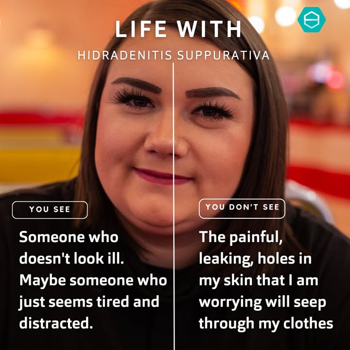 💜 Share with someone who needs to see this or who needs to understand life with hidradenitis suppurativa better.

#hidradenitissuppurativa #HSWarrior #BeAGP #MedTwitter #DermTwitter #health