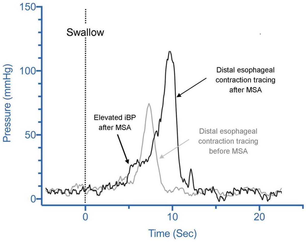 Sayazi's tweet photo. 👩‍⚕️🧑‍⚕️ Starting GI or Foregut fellowship?

A solid grasp of esophageal manometry is key to preop planning for antireflux surgery.

This review in @foregut_journal discusses:
🔹 Why manometry remains essential before ARS
🔹 How motility data informs surgical choice
🔹 The rationale for tailoring procedures to physiology

A high-yield read to start your year👇

🔗 https://t.co/9mudEZLoE3

@SAGES_Updates @drkeithsiau @sepdigestiva @CarlKayMD @CelestinoGutirr @NeilFlochMD @sminaev2015 @stevenbollipo

#GITwitter #GIFellows #MedTwitter #Surgery #Foregut #EsophagealSurgery #Foregut #GERD #Manometry #Fellowship