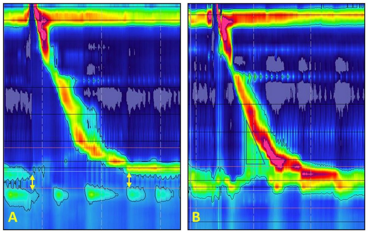 Sayazi's tweet photo. 👩‍⚕️🧑‍⚕️ Starting GI or Foregut fellowship?

A solid grasp of esophageal manometry is key to preop planning for antireflux surgery.

This review in @foregut_journal discusses:
🔹 Why manometry remains essential before ARS
🔹 How motility data informs surgical choice
🔹 The rationale for tailoring procedures to physiology

A high-yield read to start your year👇

🔗 https://t.co/9mudEZLoE3

@SAGES_Updates @drkeithsiau @sepdigestiva @CarlKayMD @CelestinoGutirr @NeilFlochMD @sminaev2015 @stevenbollipo

#GITwitter #GIFellows #MedTwitter #Surgery #Foregut #EsophagealSurgery #Foregut #GERD #Manometry #Fellowship