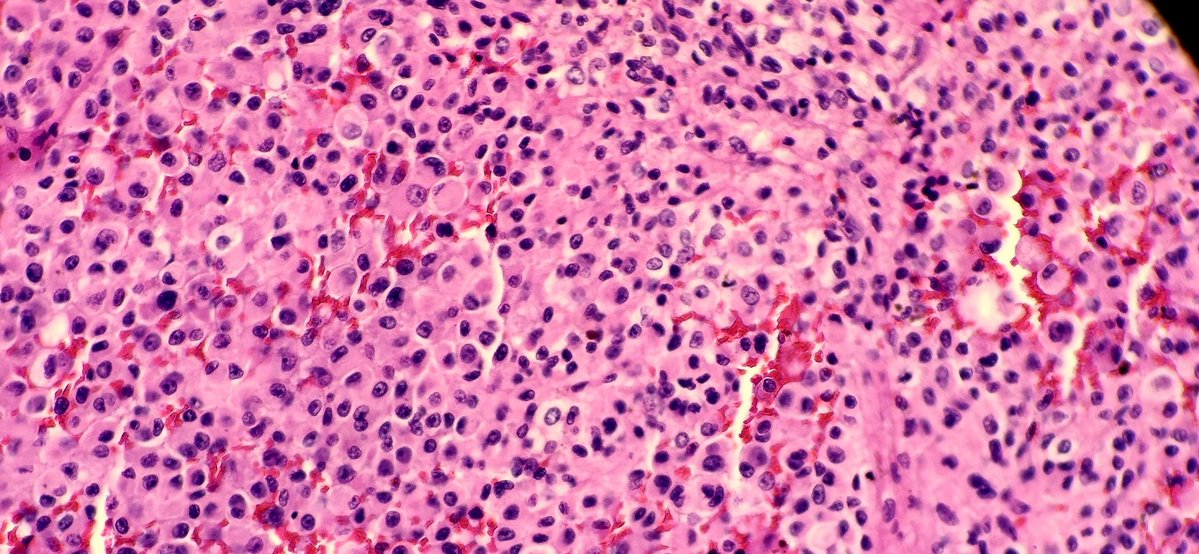 A middle-aged female patient with a brain lesion, known to be medically free.
In this case, what should be our initial thoughts? And what is the top differential diagnosis?
#PathTwitter #Neuropath 
(1)