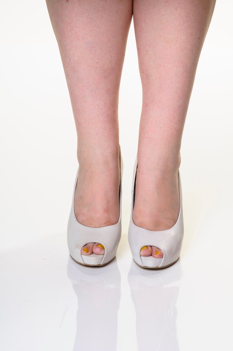 FootAnkleGP's tweet image. You don’t have to live with bunions. Early intervention makes a big difference. Let's talk.
#StepSmart #FootRelief
bit.ly/3JZoxlW