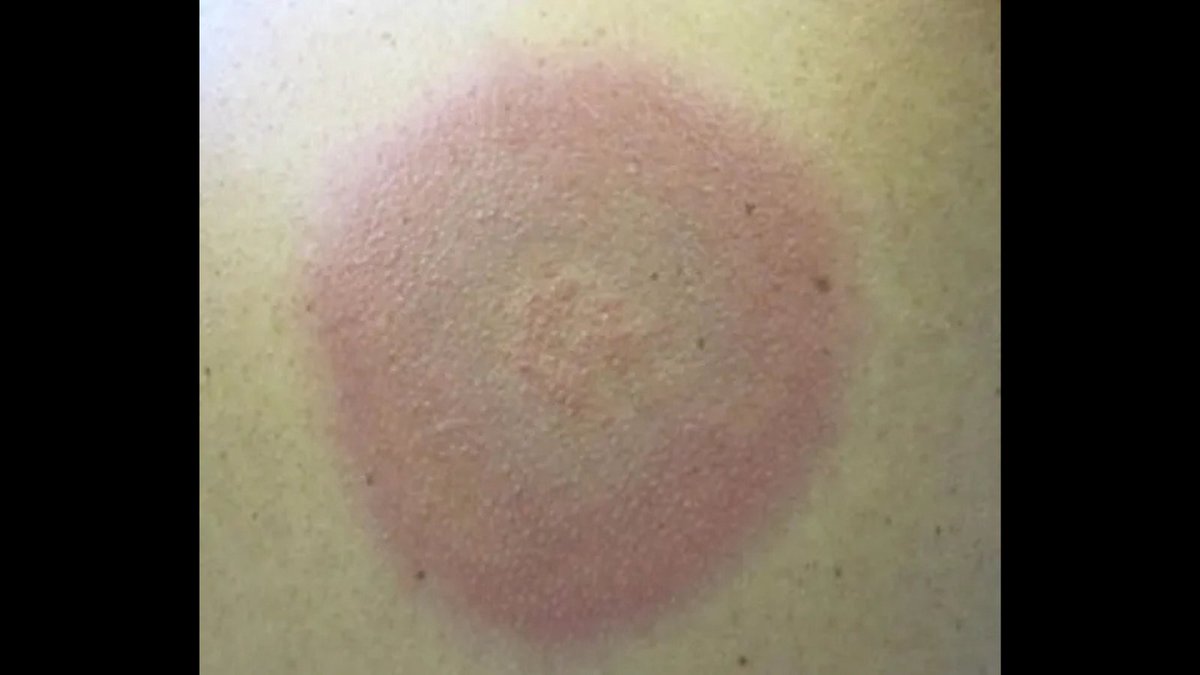 Not every erythema means infection. Could this be #Lyme… or early #SLE, #PsoriaticArthritis, or something else entirely? Challenge your diagnostic eye with 8 clinical scenarios. Quiz: When does a rash signal systemic rheumatic disease? bit.ly/4lV69Lg  #RheumTwitter