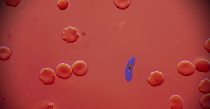 NatureMicrobiol's tweet image. Out Now! Fighting malaria as a patient and scientist bit.ly/40V6pSe #Malaria #PublicHealth #GlobalHealth