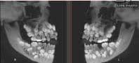 MdParagon's tweet image. 🦷 Hyperdontia — a rare condition where extra teeth (supernumerary teeth) grow beyond the normal number.
It can cause crowding, pain, and delayed eruption.
Early dental X-rays help detect and manage it.
#DentalFacts #Hyperdontia #OralHealth #MedicalX