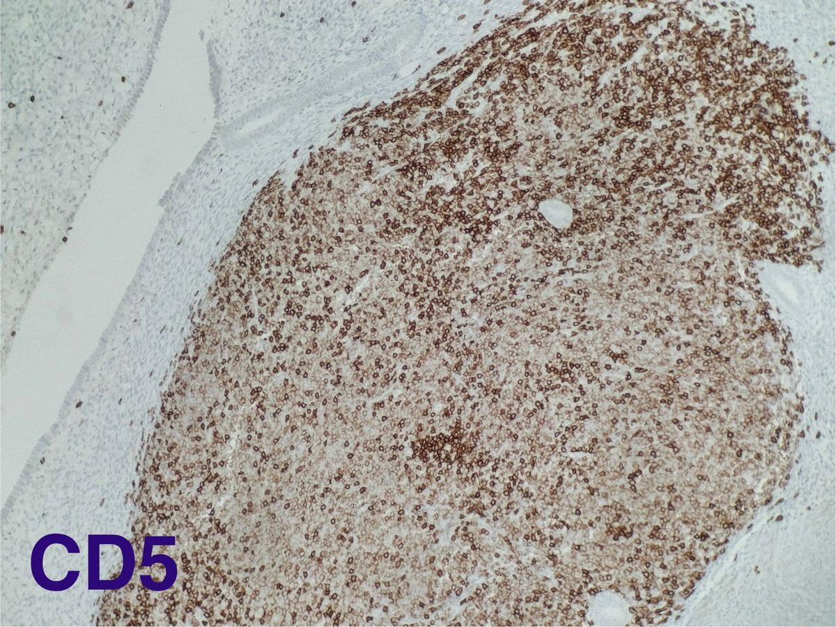 Hysterectomy specimen! Please note the lymphoid aggregates at the endomyometrial junction!  What’s the diagnosis?