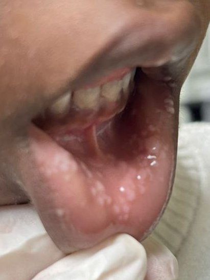 Epithelial hyperplasia