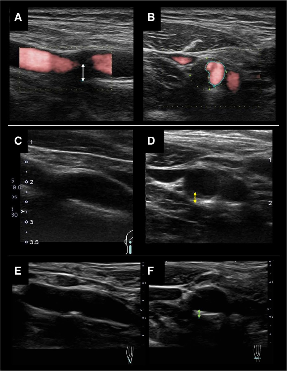 #STROKE Images: Resolution of carotid artery stenosis with anti-atherosclerotic drug treatment only. 💊
#AHAJournals ahajrnls.org/454mVSr
