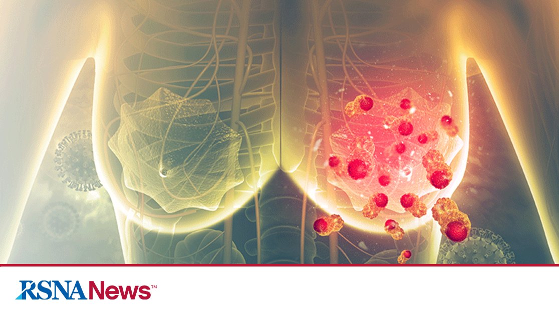 RSNA's tweet image. An AI model trained to detect abnormalities on breast MR images accurately depicted tumor locations and outperformed benchmark models when tested in three different groups, according to a study published in Radiology. bit.ly/4m1pb2N