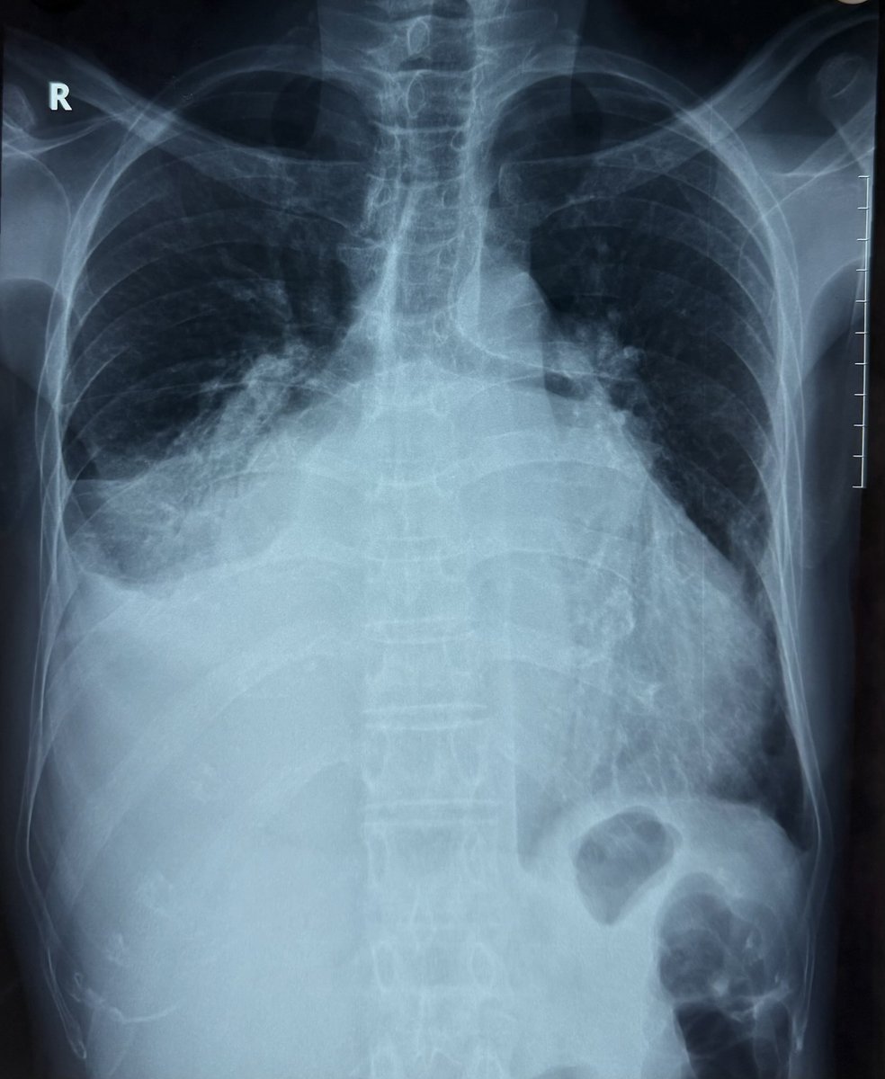 “Splaying of carina” or “flattening of Carina”? Terminal phases of RHD!! There are people not willing to get operated, go on suffering and thus teaching us the natural history of diseases many of which are available only in text books. Qn to fellows, what is normal carinal angle?