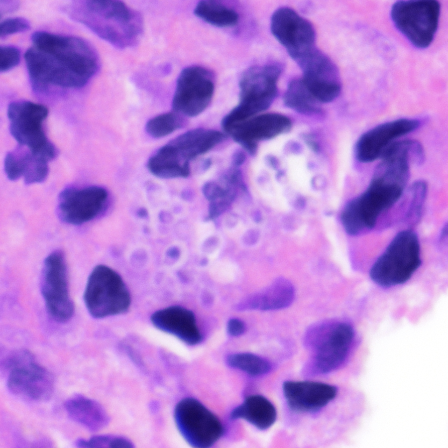 CraigHorbinski's tweet image. Multiple intracerebral ring-enhancing lesions. Diagnosis? (These images are so good, they might make HISTOry.😁) #pathology #neuropath #PathTwitter