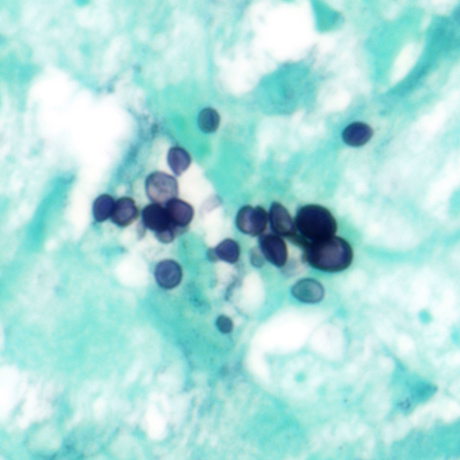 CraigHorbinski's tweet image. Multiple intracerebral ring-enhancing lesions. Diagnosis? (These images are so good, they might make HISTOry.😁) #pathology #neuropath #PathTwitter