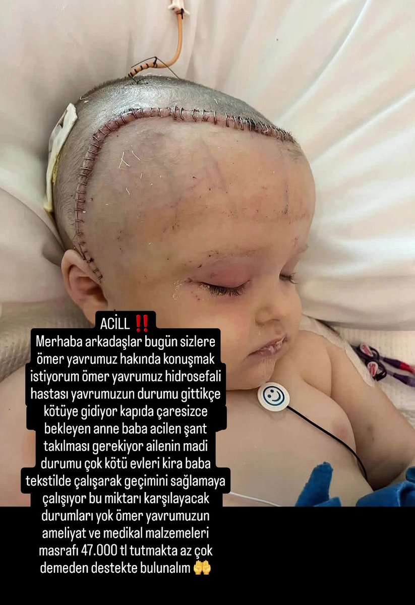 cok uzgunum lutfen elden ele yayalim ve bu minik bebegi kurtaralim 
TR410006200117300006655011
Mehmet Ali Akgül Garanti Bankası 
(yardimci olabilecek kisiler yardımı yaptiktan sonra instagram.com/insanlara_umut… bu Instagram hesabina dekont atarsa cok sevinirim..)