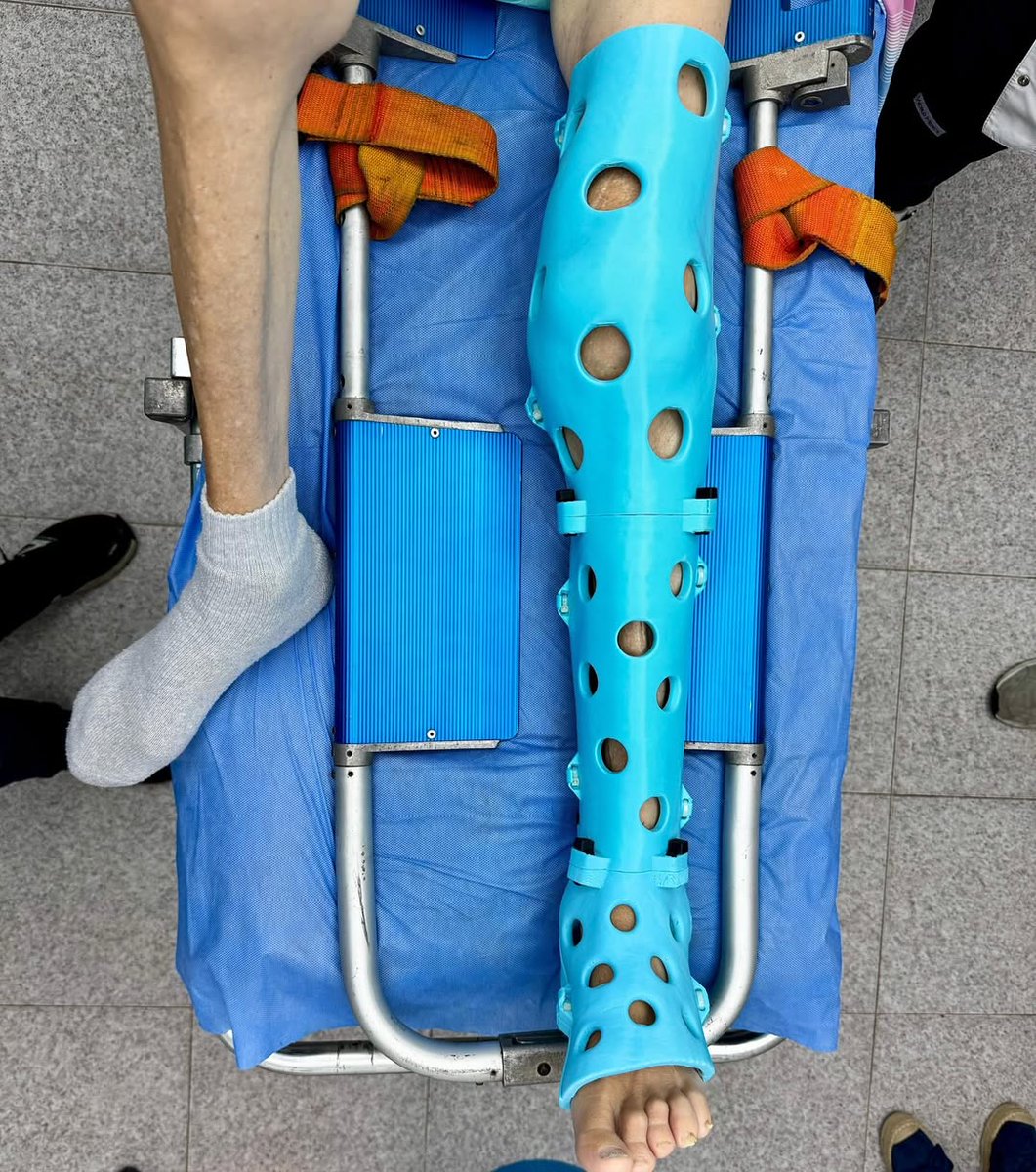 ActivArmor's tweet image. ActivArmor offer more comfortable, lighter, cooler, &amp;amp; hygienic recovery with our 3D printed technology.  @ActivArmorVZLA  #traumatología #yeso #fractura #ferula #yeso3d #geriatria #activarmorvzla #medicinaderehabilitación #ActivArmor #WaterproofCast #CastClaustrophobia