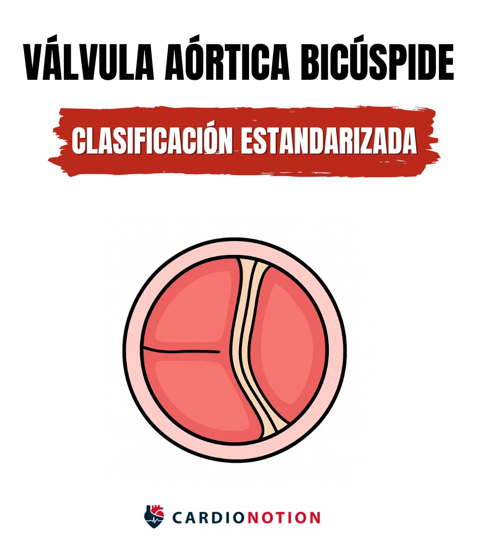 ¿Sabes clasificar la Válvula Aórtica Bicúspide?

⚠️ Muchos médicos todavía utilizan clasificaciones obsoletas

🌍 En 2021, una colaboración internacional ofreció una clasificación estandarizada.

Te hemos preparado un resumen 👇🧵#CardioNotion #CardioEd #POCUS