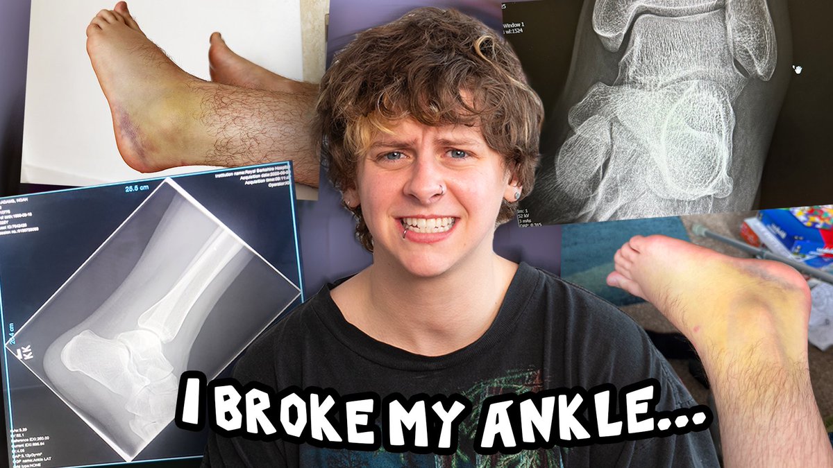 I JUST POSTED A 22 MINUTE VIDEO WHERE I WENT INTO EXPLICIT (and embarrassing) DETAIL ABOUT HOW I BROKE MY ANKLE…

STOP ASKING HOW I DID IT AND WATCH XOXO 

youtu.be/jGiW-V0EQpY?si…