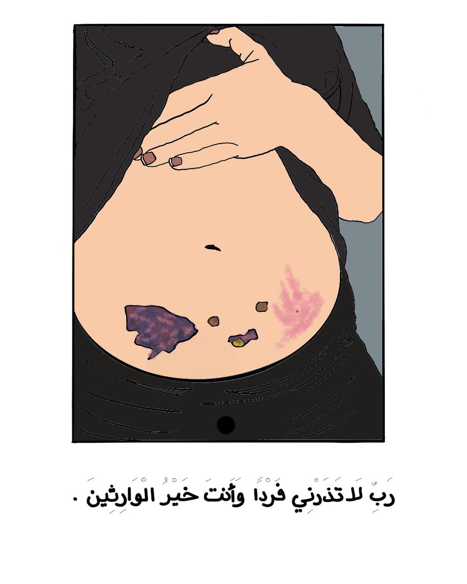 SomeoneArts's tweet image. ' My #bruised yet smiley #belly 

#IVF #ivfmedication

رب لا تذرني فزاد و انت خير الوارثين