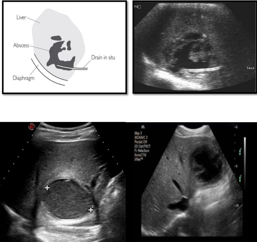 Liver abscess 
 Thick wall with Irregular margin
 Contain ‘lumpy’ echo-bright debris (turbid content)
 Display variable postacoustic enhancement
 If the abscess contains gas intense reverberations are seen.
#ultrasound 
#sonologist