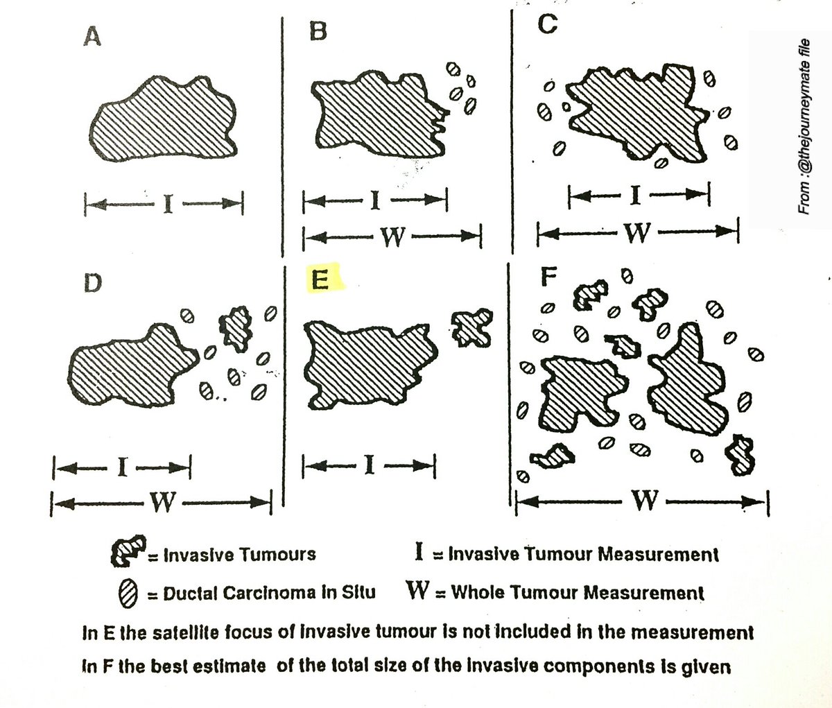 An Illustrative Guide on How To Measure Breast Tumors With Different Proportions and Distributions of DCIS and Invasive Carcinoma.🔬
