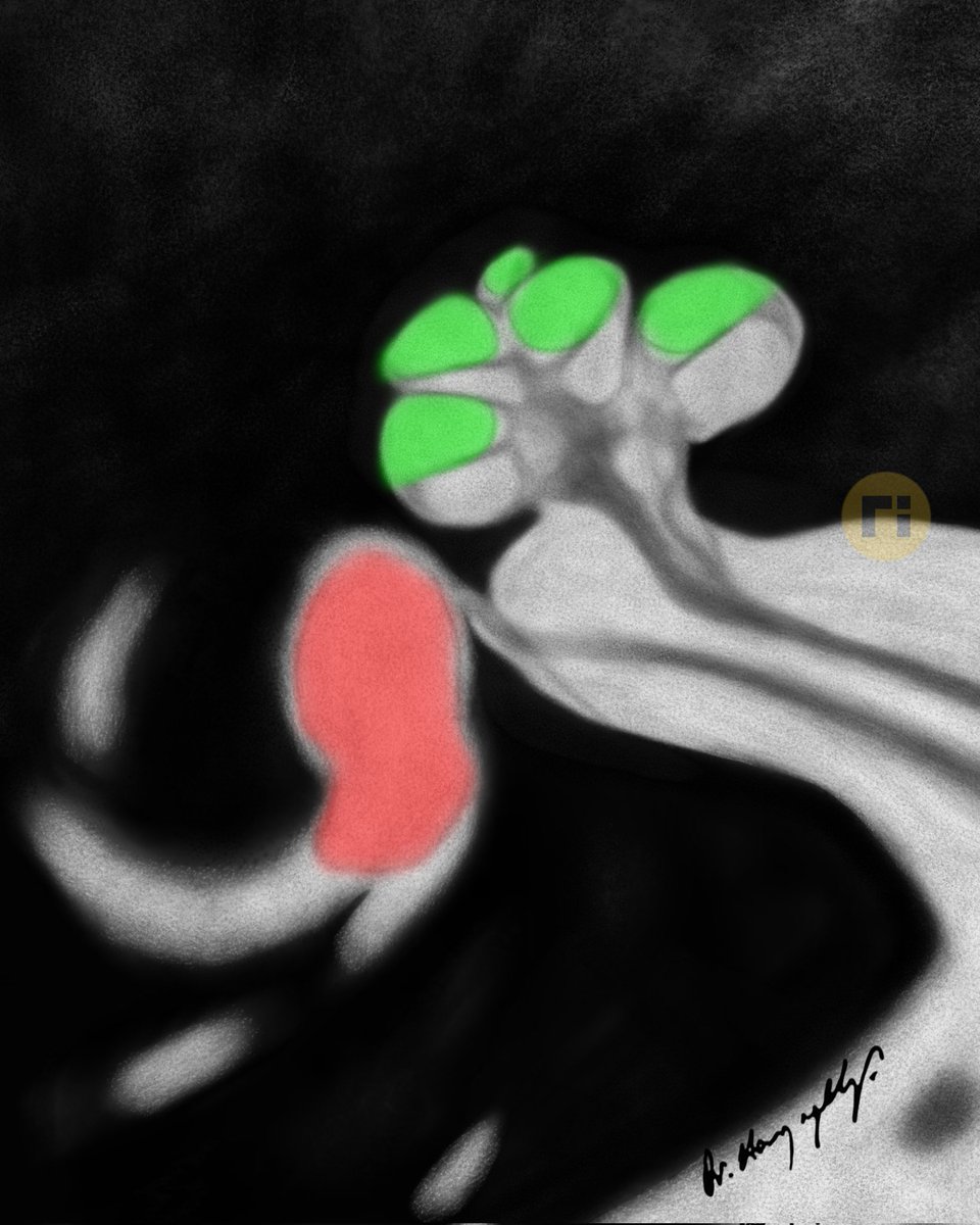 drharunyildiz's tweet image. Endolymphatic Hydrops
doi.org/10.1007/s00234…
#radiologicalillustration ✍️
pixel by pixel handmade!