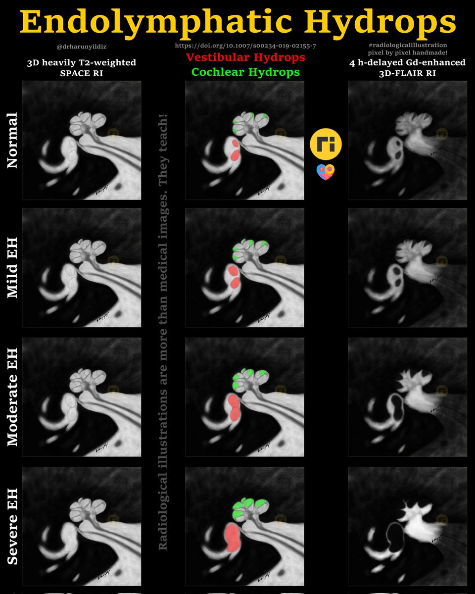 drharunyildiz's tweet image. Endolymphatic Hydrops
doi.org/10.1007/s00234…
#radiologicalillustration ✍️
pixel by pixel handmade!