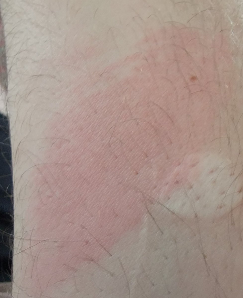 NotRyanMcD's tweet image. I should attempt not to let the 425 degree oven close on my arm next time