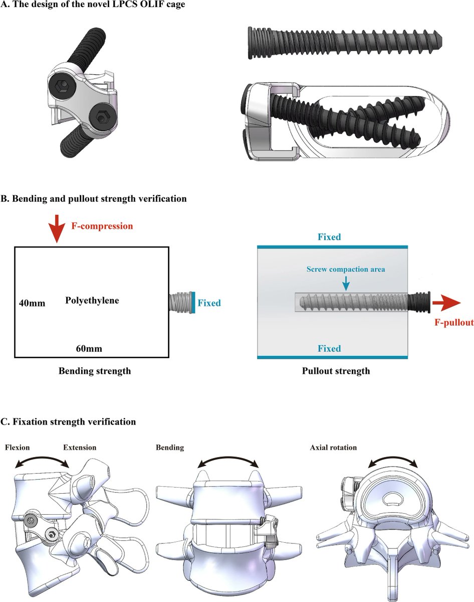 ABMEjournal's tweet image. When spinal fusion surgery doesn’t provide enough stability, patients face real risks, from persistent pain to hardware failure.
A team of researchers investigated whether a newly designed oblique lumbar interbody fusion (OLIF) cage with an integrated low-profile plate and cross…