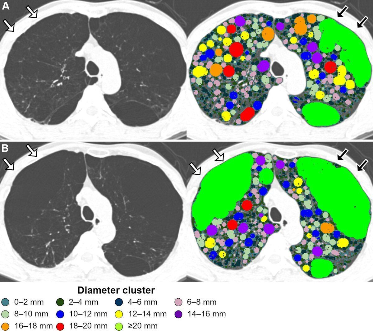 AuntMinnie's tweet image. CT reveals changes in lung holes in emphysema patients #radiology #CT #emphysema buff.ly/5H0G5uS