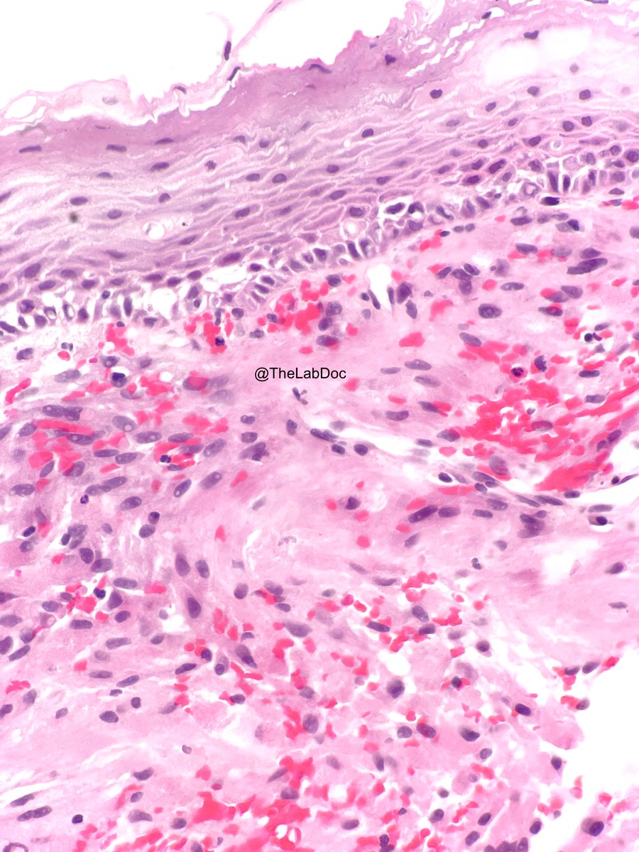 Submucosal syncytium: Granular cell tumor of esophagus
🔴Pseudoepitheliomatous hyperplasia of overlying mucosa (🚫SCC)
Granular eosinophilic cytoplasm (lysosomes)
Indistinct cell borders, ±interspersed blood vessels (🚫vascular lesions)
Schwann cell origin (S100+)
#PathTwitter