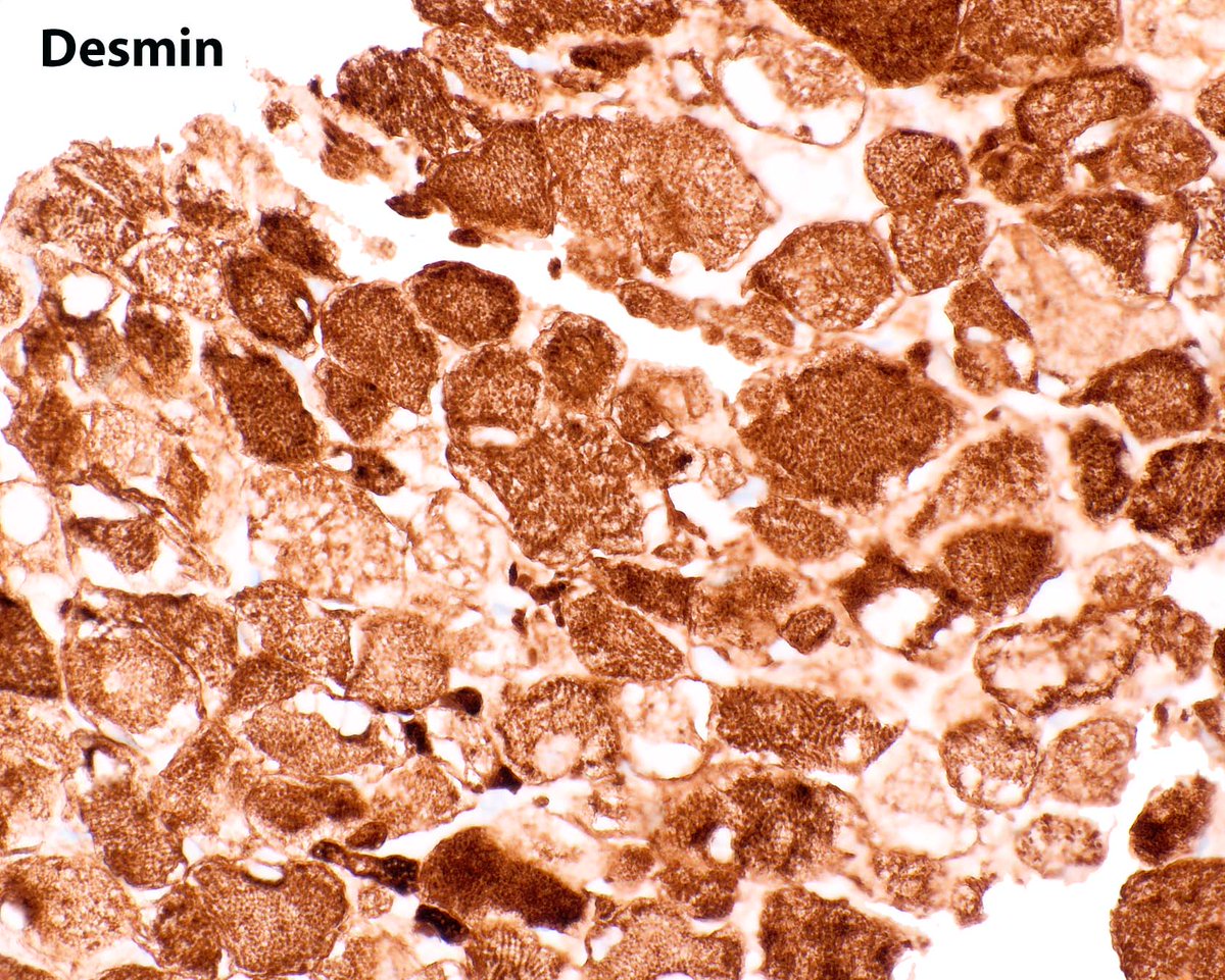 Elizabeth Montgomery, MD (@lizmontgomerymd) on Twitter photo A lovely rare classic - an adult rhabdomyoma associated with the esophagus. The desmin highlights peculiar striations. A lovely rare classic - an adult rhabdomyoma associated with the esophagus. The desmin highlights peculiar striations.