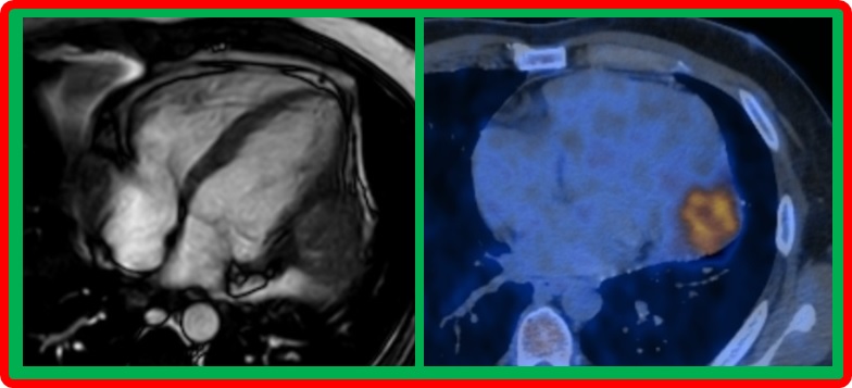 Paciente con tumor cardíaco infiltrante.
Participa de la toma de decisiones diagnósticas y terapéuticas en el ateneo del Instituto de Medicina Cardiovascular del Hospital Italiano 🇮🇹

El Miércoles 16/7 - 13hs

Por Zoom 
us02web.zoom.us/j/2701918987?p…

ID 270 191 8987
Código ateneo