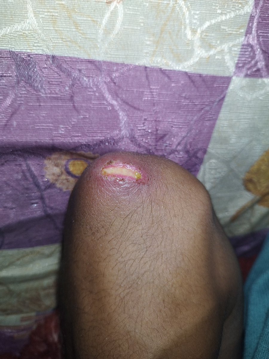 mosa_gaza7's tweet image. please don't ignore me!!๐๐ฟ
This is my injury to my hand from shrapnel from the missile that the occupation bombed next to our tent๐
Please help us, my family and I are dying in Gaza๐๐
Donate here please it will help๐๐ฟ๐
gofund.me/a01d527c