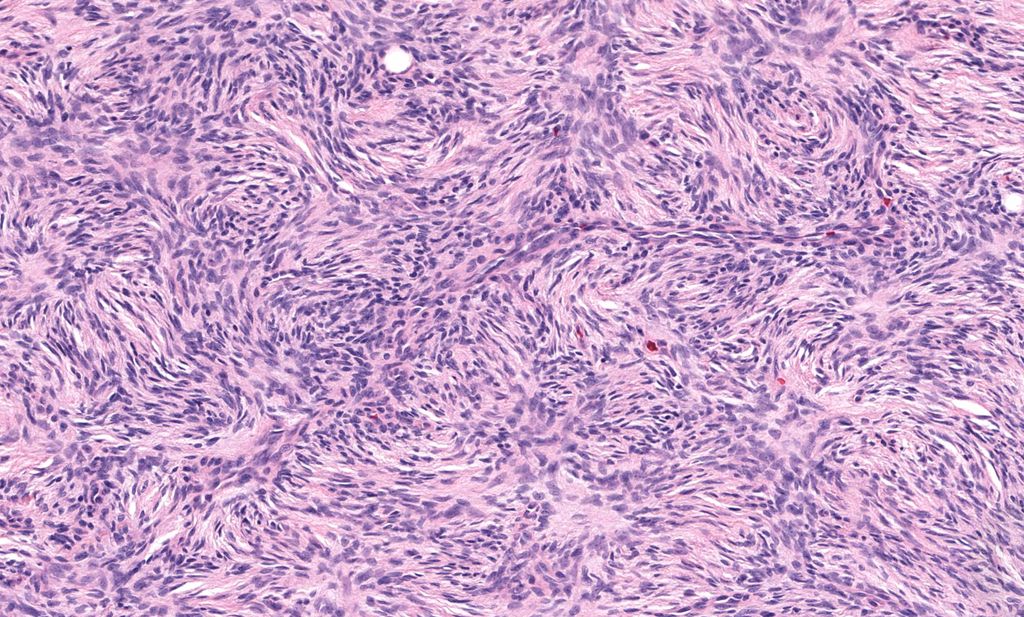 Jerad Gardner, MD (@jmgardnermd) on Twitter photo What is the name for this spindle cell pattern? What tumor is it classically seen in?
Answer ✅ youtu.be/3u7uL9asZDg?si…
More info: kikoxp.com/posts/10744
WSI digital slides: kikoxp.com/posts/6818
#pathology #pathologists #pathTwitter #dermpath #dermatology #dermtwitter What is the name for this spindle cell pattern? What tumor is it classically seen in?
Answer ✅ youtu.be/3u7uL9asZDg?si…
More info: kikoxp.com/posts/10744
WSI digital slides: kikoxp.com/posts/6818
#pathology #pathologists #pathTwitter #dermpath #dermatology #dermtwitter