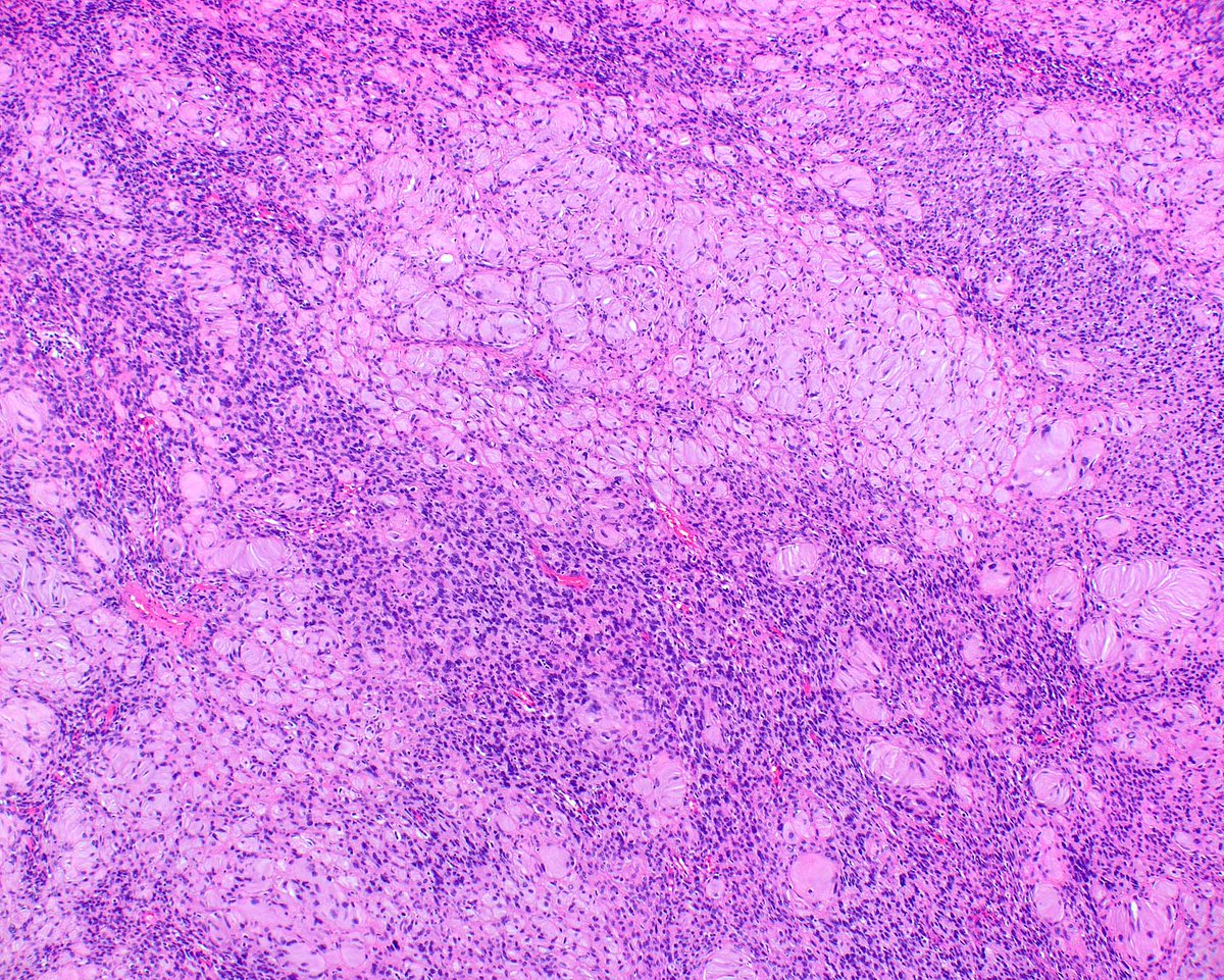ModernPathology's tweet image. H3K27me3 loss is good but not perfect for confirming a diagnosis of malignant peripheral nerve sheath tumor; this one arose in a diffuse neurofibroma.
1: Schaefer IM, Fletcher CD, Hornick JL. Loss of H3K27 trimethylation distinguishes malignant peripheral nerve sheath tumors from…