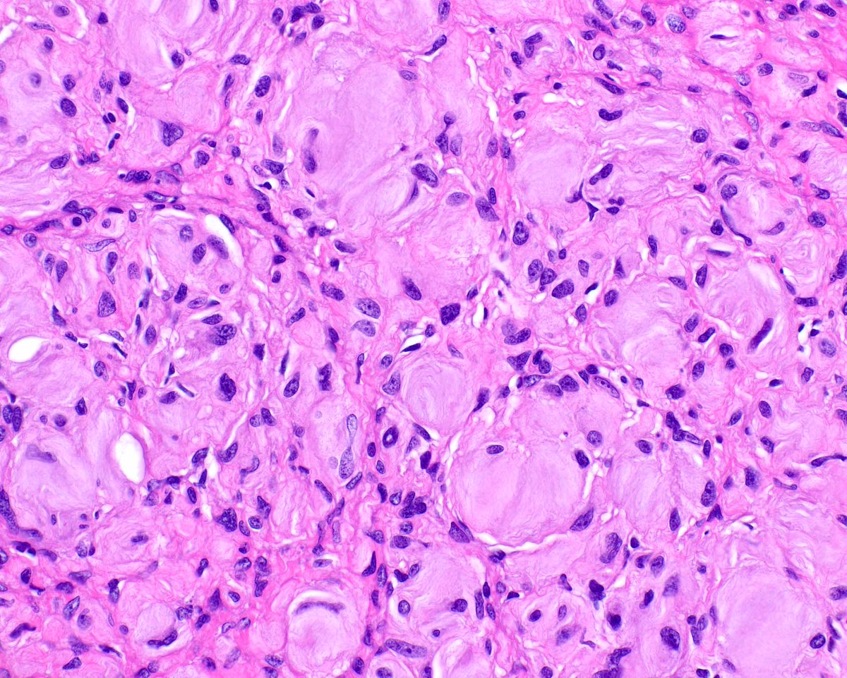 ModernPathology's tweet image. H3K27me3 loss is good but not perfect for confirming a diagnosis of malignant peripheral nerve sheath tumor; this one arose in a diffuse neurofibroma.
1: Schaefer IM, Fletcher CD, Hornick JL. Loss of H3K27 trimethylation distinguishes malignant peripheral nerve sheath tumors from…