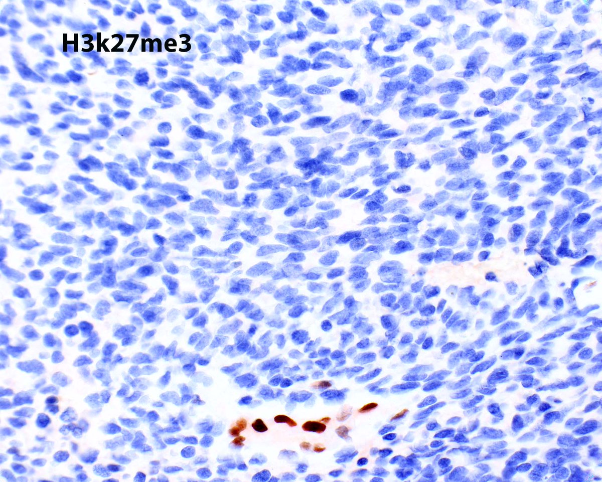 ModernPathology's tweet image. H3K27me3 loss is good but not perfect for confirming a diagnosis of malignant peripheral nerve sheath tumor; this one arose in a diffuse neurofibroma.
1: Schaefer IM, Fletcher CD, Hornick JL. Loss of H3K27 trimethylation distinguishes malignant peripheral nerve sheath tumors from…