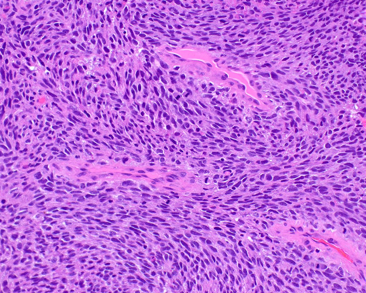 ModernPathology's tweet image. H3K27me3 loss is good but not perfect for confirming a diagnosis of malignant peripheral nerve sheath tumor; this one arose in a diffuse neurofibroma.
1: Schaefer IM, Fletcher CD, Hornick JL. Loss of H3K27 trimethylation distinguishes malignant peripheral nerve sheath tumors from…