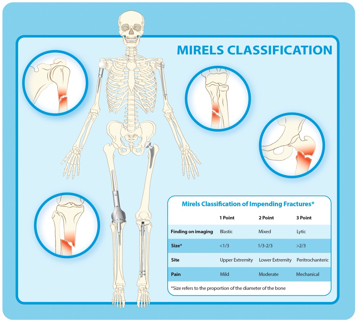 CurrentOncology's tweet image. π
New #Review in #Vol32_Iss6
π "Predicting the Risk for Pathological Fracture in Bone Metastases"
βοΈ by Pavlos Altsitzioglou et al.
π Access the full paper here: brnw.ch/21wUaQX