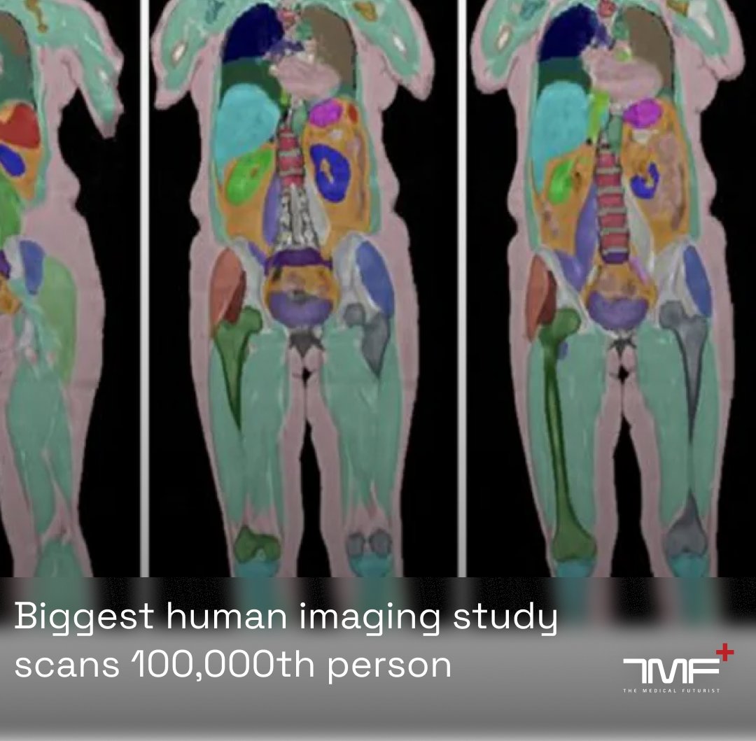 Berci's tweet image. Steve is the hero of the current digital health and AI revolution!
Without people like Steve, there would be no revolution, as that is based on the precious data of patients.
"The world's biggest human imaging project says it has now hit its target of scanning the brains,…