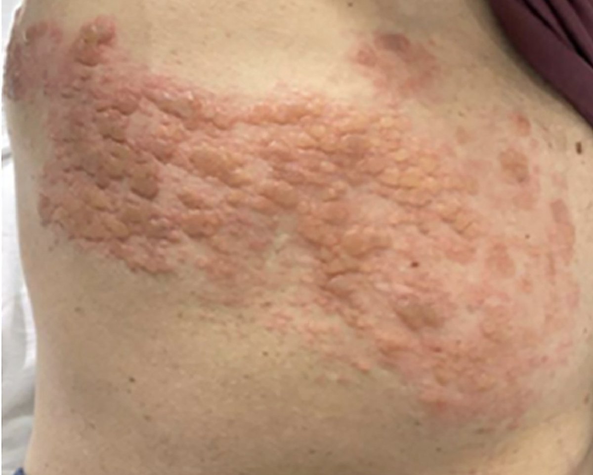 JEM Case of the Week: 54 yo M w/ s/p heart transplant presents with chest wall pain and the following rash.  While waiting for an inpatient bed, his pain continues despite multiple narcotics.  What is your next step for pain control?  Answer posted Friday #medtwitter <a href="/aaeminfo/">AAEM</a>