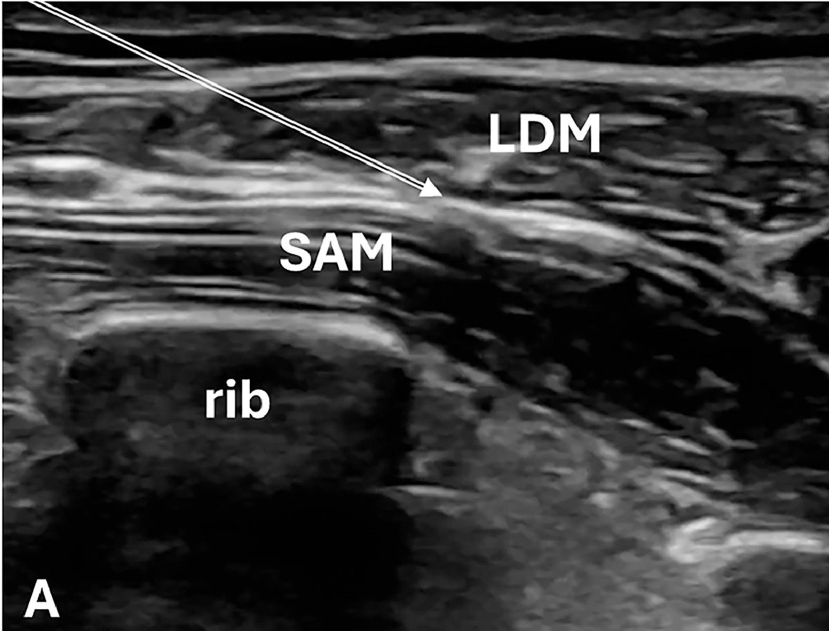 JEM Case of the Week Answer: Pain from Zoster?  How about a #POCUS guided Serratus Anterior Plane Block!  Check out the full case here. <a href="/UPennEM/">Penn EM Residency</a> <a href="/aaeminfo/">AAEM</a>  #medtwitter jem-journal.com/article/S0736-…