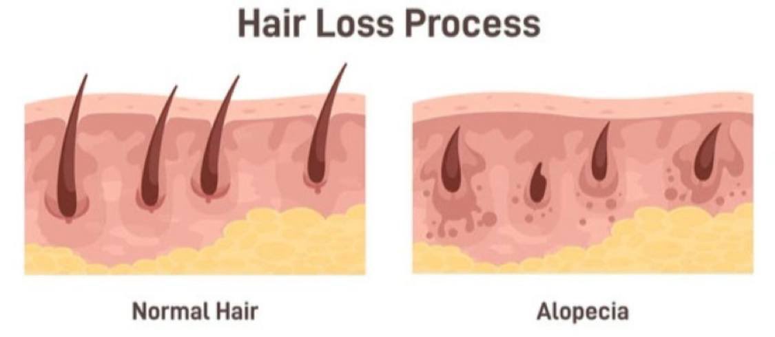 IronSage_'s tweet photo. Every person over 35 blames aging for having less hair.

Turns out it's not age.

It's hormones, blood flow, and years of neglect.

Here are 3 simple fixes to prevent hair loss and reverse hair loss naturally: https://t.co/L5awItIxxj