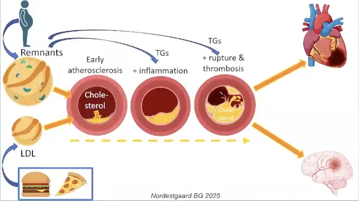 pzhong2016's tweet image. Remnant Cholesterol and Triglyceride-Rich Lipoproteins
vumedi.com/video/remnant-…