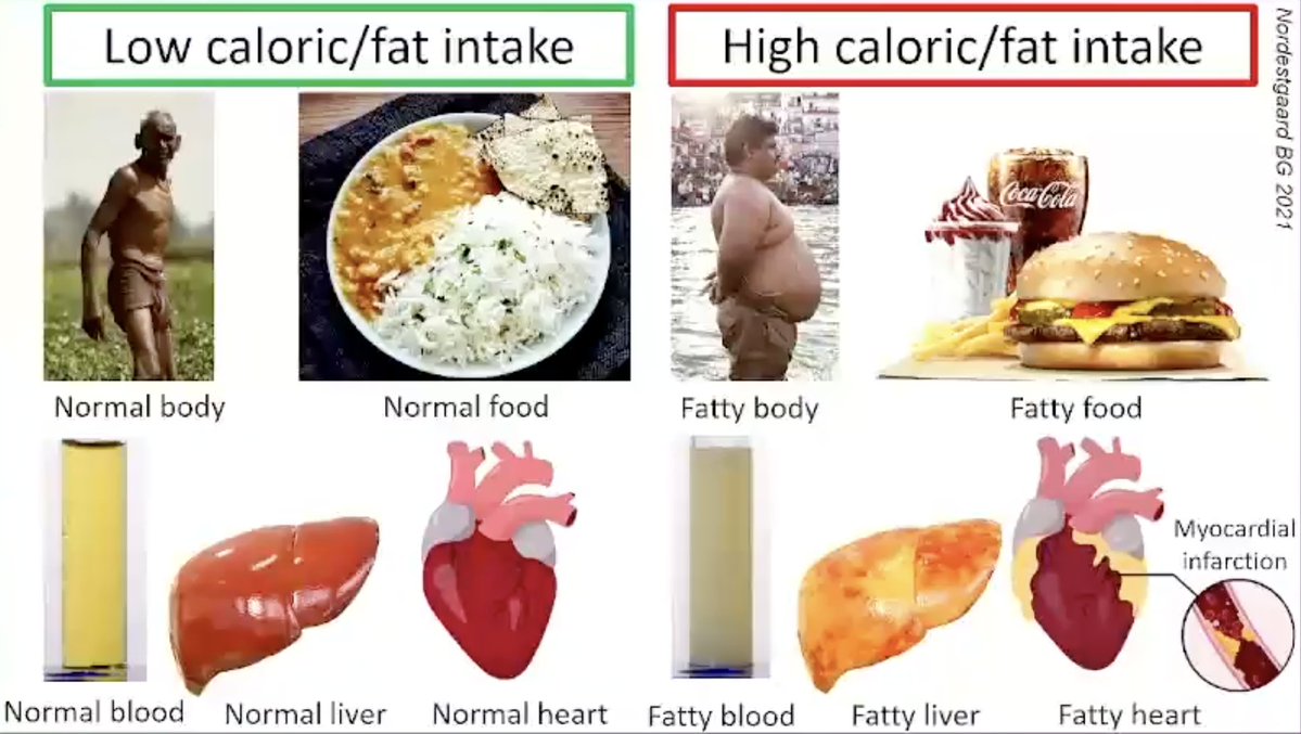 pzhong2016's tweet image. Remnant Cholesterol and Triglyceride-Rich Lipoproteins
vumedi.com/video/remnant-…