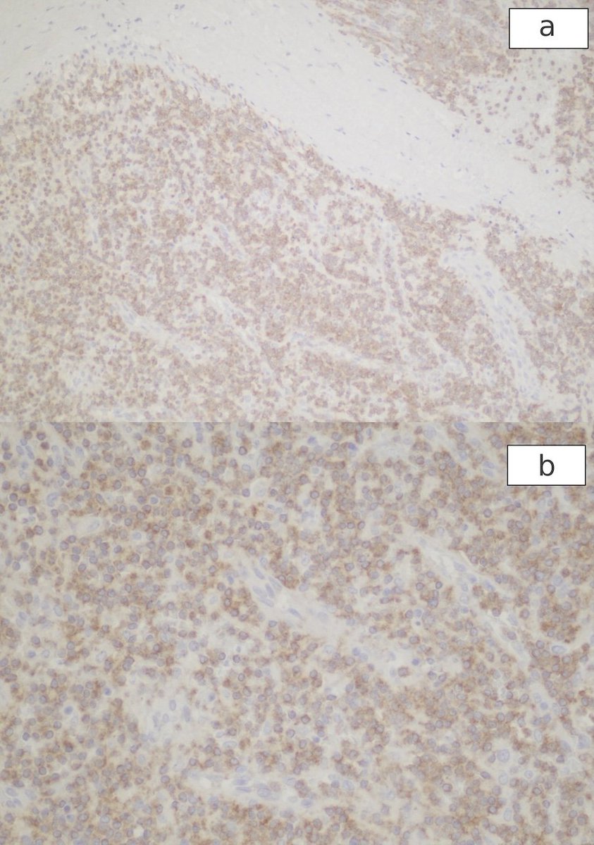 J_Hematology's tweet image. Hairy Cell Leukemia With Splenic Rupture: Hematological Changes and Disappearance of Hairy Morphology After Splenectomy
jh.elmerpub.com/jh/article/vie…
Keywords: Hairy #cell #leukemia; #Splenectomy; Hairy cell #morphology