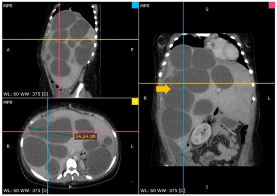 🧫 Two extreme cases. One complex disease.
This review explores the spectrum of complications in liver cystic echinococcosis and highlights clinical challenges.

📖 brnw.ch/21wUaZe
#Hepatology #Parasitology #Radiology
