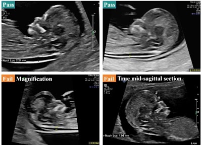 Radiology: Artificial Intelligence (@radiology_ai) on Twitter photo Artificial Intelligence Model for Real-Time Prenatal Nuchal Translucency Assessment: High Performance and Workflow Integration doi.org/10.1148/ryai.2… <a href="/ShenzhenUni/">Shenzhen University</a> #prenatal #ultrasound #MachineLearning Artificial Intelligence Model for Real-Time Prenatal Nuchal Translucency Assessment: High Performance and Workflow Integration doi.org/10.1148/ryai.2… <a href="/ShenzhenUni/">Shenzhen University</a> #prenatal #ultrasound #MachineLearning