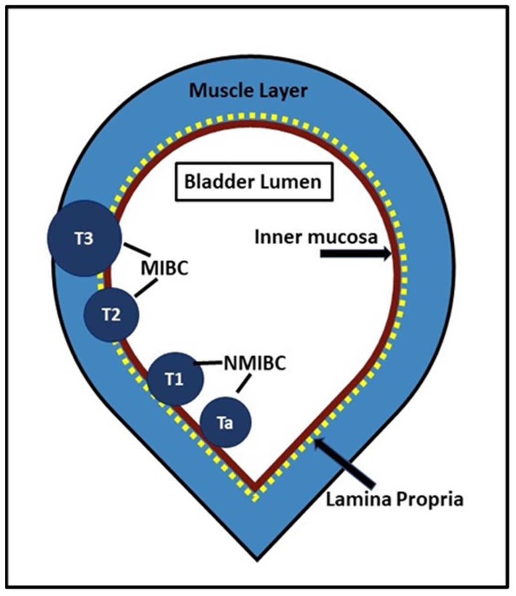 CurrentOncology's tweet image. π₯ #HighCitedPaper
βπ» Intravesical Contrast-Enhanced MRI: A Potential Tool for Bladder Cancer Surveillance and Staging
Read more here π brnw.ch/21wUb4T
π Cited more than 5 times!
#BladderCancer #Staging #MRI