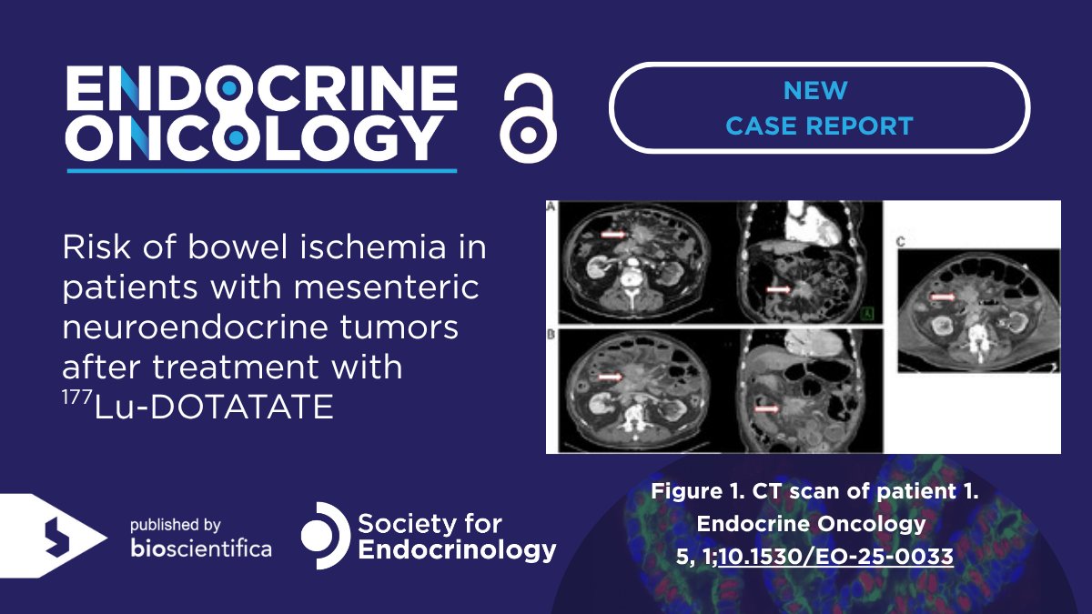 Endocrine Oncology (@endooncology) on Twitter photo A new case report by <a href="/pelle_eleonora/">Eleonora Pelle, MD</a> et al. reviews three patients with mesenteric NETs, shedding light on the potential risk of bowel ischemia linked to ¹⁷⁷Lu-DOTATATE treatment.
📖Check out the full report #OpenAccess: doi.org/10.1530/EO-25-… A new case report by <a href="/pelle_eleonora/">Eleonora Pelle, MD</a> et al. reviews three patients with mesenteric NETs, shedding light on the potential risk of bowel ischemia linked to ¹⁷⁷Lu-DOTATATE treatment.
📖Check out the full report #OpenAccess: doi.org/10.1530/EO-25-…